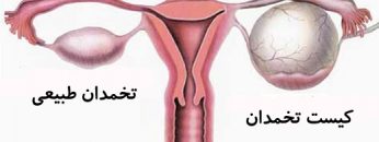 درمان-کیست-تخمدان-از-راه-طبیعی-سلامت-زنان