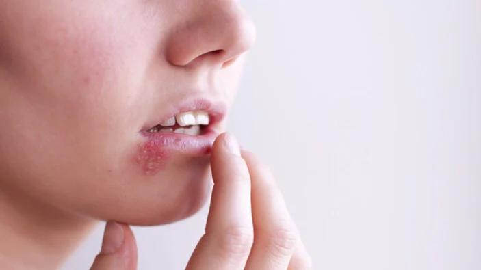 روش های طبیعی بر طرف کردن اوچوک. عفونت روی لب طبخال